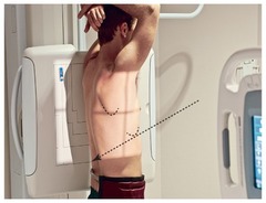 <p>- Drop Image Receptor about an inch</p><p>- Gonadal Shielding</p><p>- Arms above head</p><p>- Chin up</p><p>- CR T7 & MCP (Mid Coronal Plane)</p><p>- No Rotation </p><p>- Lower IR 1"</p><p>- 72" SID</p><p>- Large IR</p><p>- AEC (Center)</p><p>- Hold breath on 2nd inspiration</p><p>- 110-125 kVp</p>