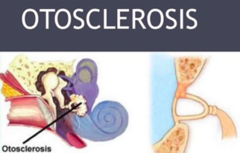 <p>Caused by abnormal bone remodeling in the middle ear which is a usually a lifelong process which bone tissue renews itself by replacing old tissue with new.</p><p>Abnormal remodeling disrupts the ability of sound to travel from the middle ear to the inner ear.</p><p>Many thought to be inherited</p>