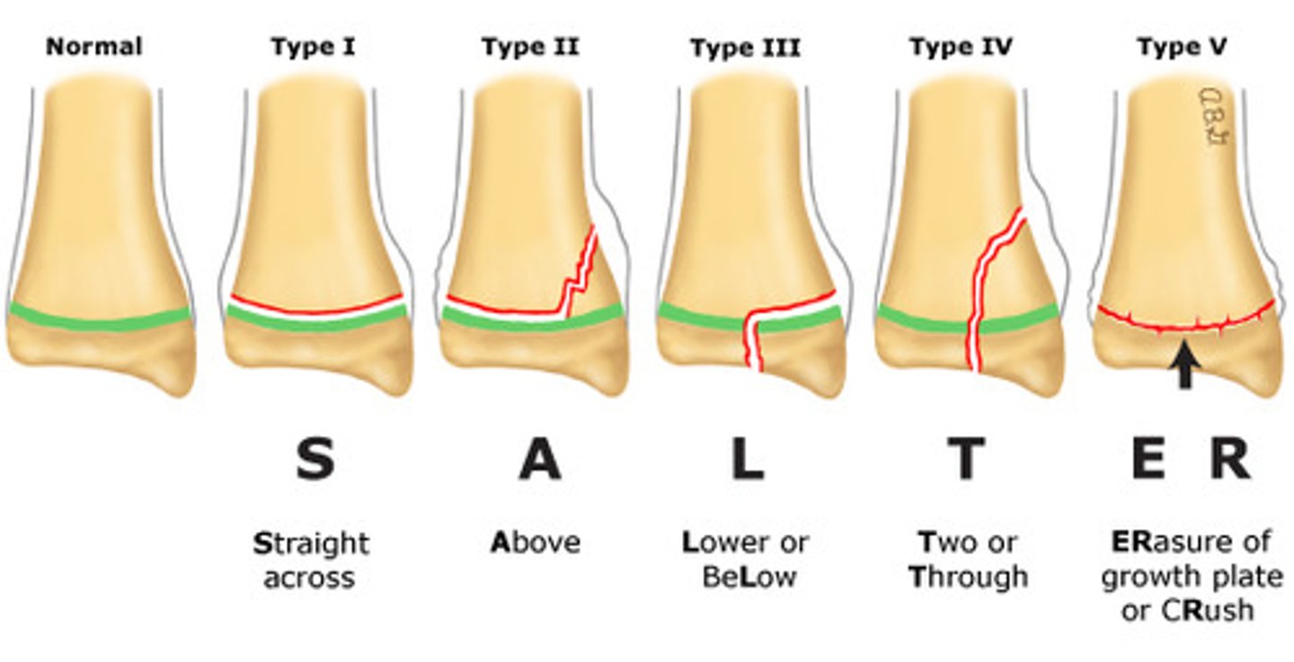 <p>Salter-Harris Fractures:</p><p>Classification system used to diagnose fractures through or involving the physis (growth plate) in children</p><p>think: “SALTeR” (slipped, above, lower, through everything, rammed/ruined)</p>