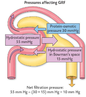 <p>remember, GFR is the speed of fluid moving through the kidney tubules</p><p>(55 – 15) – 30) = 10</p><p>• Unregulated influences on GFR.</p><p><span style="color: purple;">Decrease in plasma protein</span> re<span style="color: purple;">duces pulling force opposing filtration </span>so this i<span style="color: purple;">ncreases GFR </span>(<strong>burn patients/ liver disease</strong>).</p><p>cos basically less plasma protein in the blood because of this burn patient/liver disease case, less pulling force from water exiting the kidney tubule (osmosis) and entering the blood the vessel, so the blood vessel pressure stays low, and the tubule stays high, so the GFR stays high because the GFR measures the speed of fluid moving through the kidney tubules</p><p>• E.g. (55 – 15) – 20 = 20</p><p></p><p><span style="color: purple;">Plasma-colloid pressur</span>e in<span style="color: purple;">creases in dehydrating diarrhoea</span>, so <span style="color: purple;">GFR is decreased</span>.</p><p>• E.g. (55 – 15) - 35 = 5</p><p>In dehydrating diarrhoea, your body loses massive amounts of pure water. You’re losing water, not large plasma proteins, so those proteins become heavily crowded and concentrated inside your blood vessels. This creates huge osmotic pulling force from the proximal convoluted tubule, which drecreases the GFR</p><p></p><p><span style="color: purple;">Urinary tract blockag</span>e – <span style="color: purple;">increases pressure in Bowman’s capsul</span>e –<span style="color: purple;"> decreases GFR</span>.</p><p>• E.g. (55 – 20) – 15 =</p><p><span>Urinary tract is blocked, so the fluid doesn't escape into the bladder, it backs up to the ureter tubes, up the kidney tubules, and back to the bowman's capsule. This creates massive hydrostatic pressure (back-pressure), this pushes firmly against the blood capillaries, </span>and this opposing capsule pressure acts like a physical wall that blocks blood fluid from crossing the filter membrane to the point filtration stalls, causing GFR to decrease dramatically.</p>