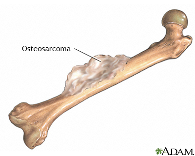 <p>Osteosarcoma</p>