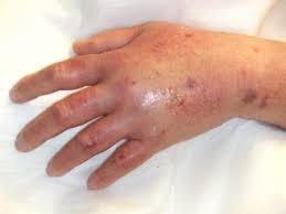 <p>S/S: swelling, discomfort, tightness. blanching, cool skin, decreased or stopped IV flow</p><p>Common in older adults, peds, obese, chronic ill</p><p></p><ul><li><p><strong>STOP IV</strong></p></li><li><p>Remove</p></li><li><p>Elevate</p></li><li><p><span style="color: rgb(223, 112, 112);">Warm compress</span></p></li><li><p>check pulse, cap refill</p></li><li><p>Document!</p></li></ul><p></p><p>Prevention: frequent assessment!</p><p></p>