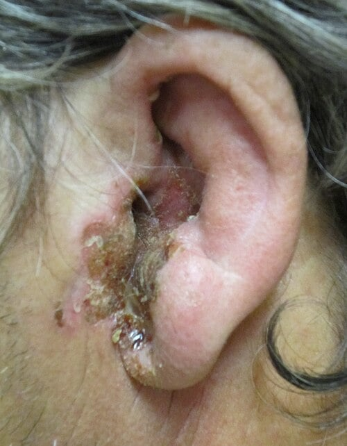 <p>Infection of the external auditory canal, most often due to Pseudomonas aeruginosa </p><p>-Presentation: ear pain and pruritus with pain on tragal manipulation, edematous canal with white/purulent debris, conductive hearing loss</p><p>-Dx: clinical, ESR, CT/MRI of temporal bone </p><p>-Tx: fluoroquinolone drops </p>