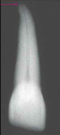 <p>When creating your access in maxillary central incisors, what should you observe in your radiograph?</p>