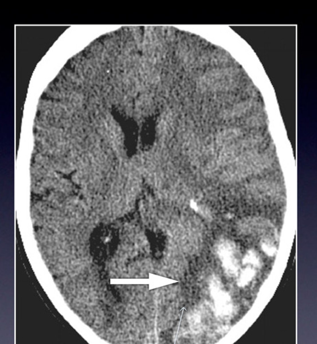 <p>a common cause of this hemorrhage in the brain is:</p>