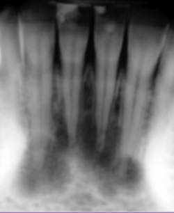 <p>which of the following is TRUE: </p><p>symptomatic </p><p>teeeth are vital </p><p>due to caries </p><p>cause deep pockets</p>