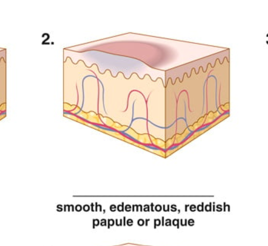 <p>smooth, edematous, reddish papule or plaque</p>
