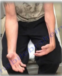 <p>Symptoms of Volkmann’s ischemic contracture </p>