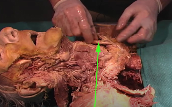 <p><span>What is this structure to which the arrow is pointing?</span></p><p> </p><p>sternocleidomastoid</p><p> </p><p>masseter</p><p> </p><p>hyoid</p><p> </p><p>Inferior alveolar nerve</p>