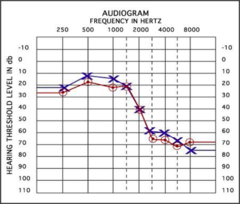 <p>SNHL reduces ability to hear faint sounds</p><p>Even when speech is loud enough to hear, it still may be unclear or muffled.</p><p>•Symmetric vs. Asymmetric</p>