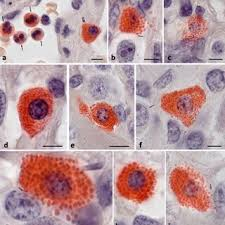 <p>naphthol ASD chloroacetate esterase results:</p><p>bright red:</p><p>blue:</p><p>unstained:</p>