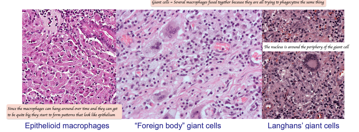 <p>Giant cells = Multi-nucleated cells formed by epithelioid macrophages fusing together </p><ul><li><p>Foreign body giant cells </p></li><li><p>Langhans’ giant cells </p></li></ul><p></p>