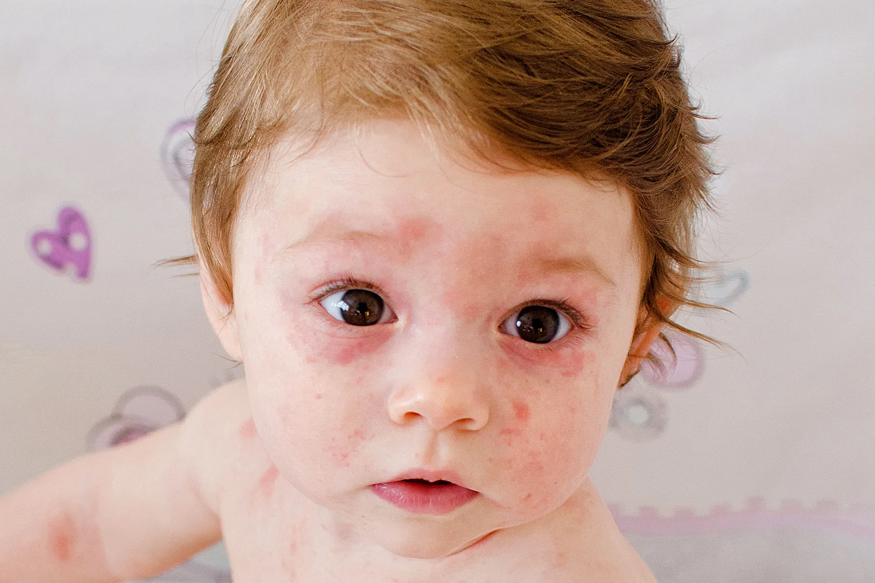 <p>Roseola</p>