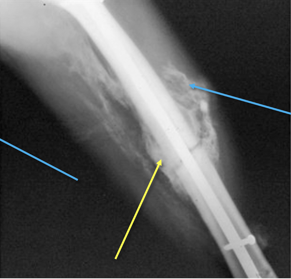 <p>What is shown in this example of a post traumatic femur?</p>