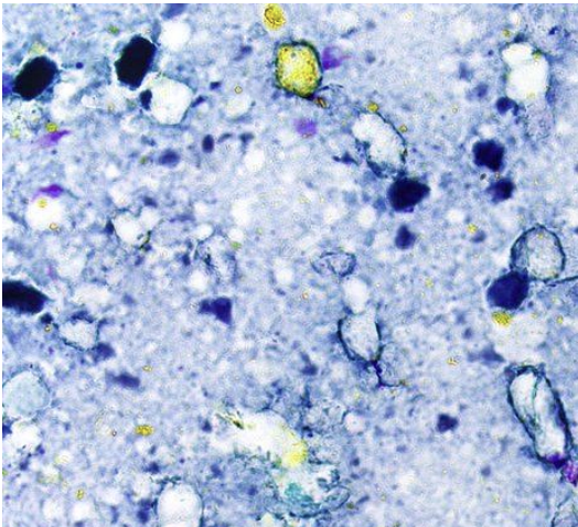 <p>kyste du pancréas</p><p>1) diagnostic</p><p>2) morphologie</p><p>3) biochimie</p><p>4) altérations moléculaire</p><p>5) risque de malignité </p>