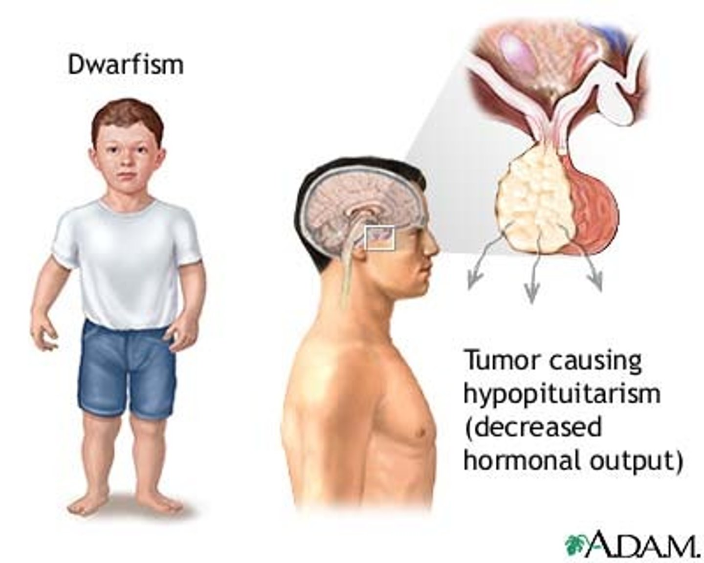 <p>Caused by an insufficient secretion of (HGH) from the pituitary, NOT GENETIC DWARFISM.</p><p>CHILDREN:</p><p>-Slow growth rate</p><p>-Normal body proportions</p><p>-Height 20-25% below average</p><p>-Normal head size</p><p>ADULTS(RARE):</p><p>-Reduced muscle mass and bone density</p><p>-Fatigue, depression and poor memory</p><p>TREATMENT: Both forms can be treated with growth hormone injections.</p>