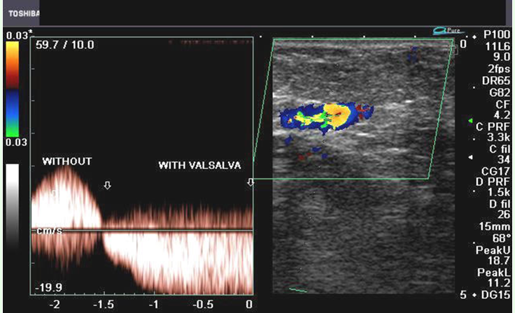 <p>normal or abn</p>