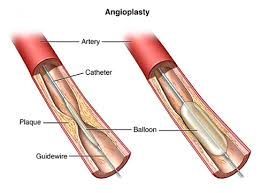 <p>A <strong>medical procedure to open narrowed or blocked blood vessels</strong>, usually by inflating a small balloon inside the artery.</p>