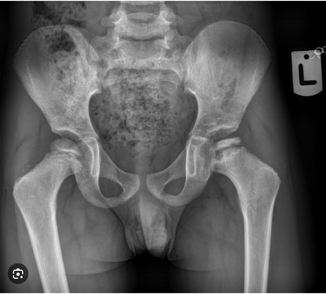 <p>AVN of the femoral epiphysis </p>