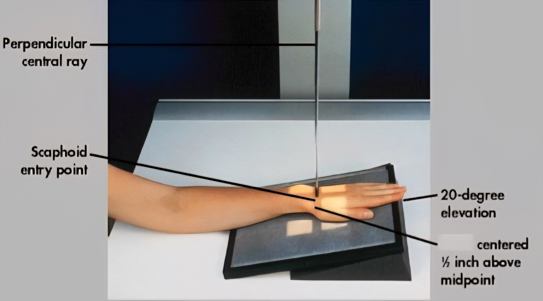 <p>PA axial projection, often with 20-degree ulnar deviation, used to visualize the scaphoid bone in the wrist without superimposition, typically to detect fractures</p>