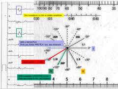 <p>1. izoelektriskais komplekss pārliecinošs nav</p><p>2. atrodam 2 novadījumus ar lielāko voltāžu - tas ir pirmais un trešais (starp tiem atrodas sirds ass)</p><p>3. skatāmies uz trešā un pirmāQRS polaritāti:</p><p>- 1. QRS ir negatīvs -> sirds ass pretēji 1. novad. asij</p><p>- 3. QRS ir pozitīvs -> dodas 3. novad. ass virzienā</p><p>+150 ass !!</p>