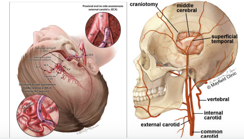 <p>takes vessel from another part of the body and bypasses the clot</p><ul><li><p><span style="background-color: transparent;">Common vessels used as a graft are the saphenous vein in the leg or the radial or ulnar arteries in the arm</span></p></li></ul><p></p>