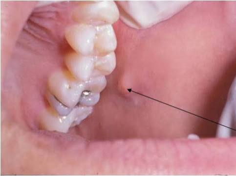 <ul><li><p>Small pink keratinized papule on buccal mucosa at the commissure of lip </p></li></ul><p></p>