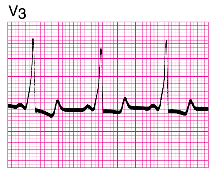 <p>What ECG is this? </p>