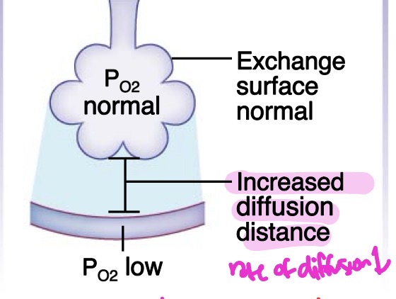 <p>Fluid in interstitial space increases diffusion distance → low PO2.</p><p>arterial PCO2 may be normal due to higher CO2 solubility in water</p><ul><li><p>rate of diffusion decreases</p></li><li><p>very similar to fibrotic lung disease — both increase diffusion distance</p></li></ul><p></p>