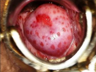 <p>típico de qual doença? como está o pH vaginal?</p>