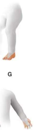 <p>this limb deficiency would be considered ___________</p>