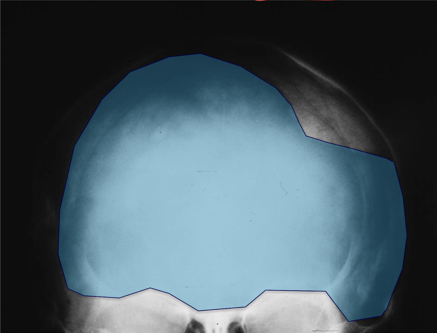 <p>What tumour like disorder is this, where is it, what can be seen?</p>