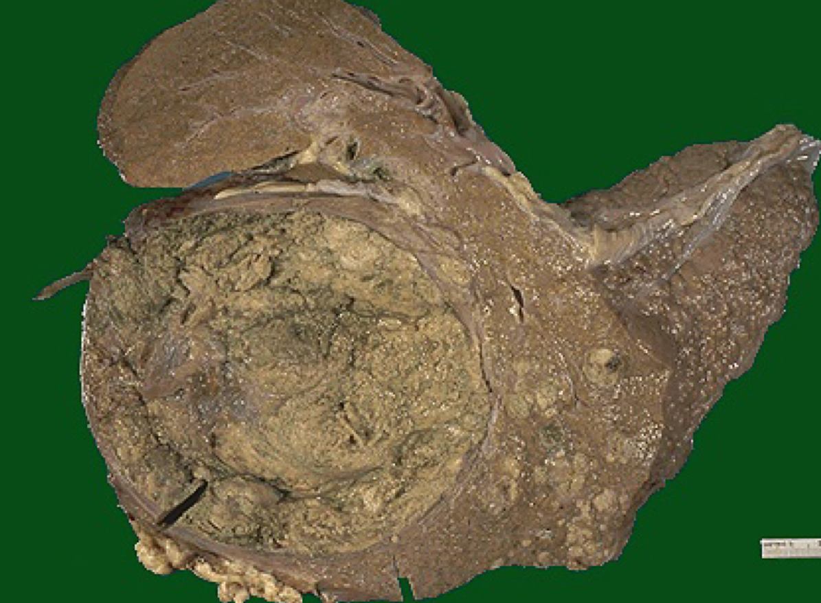 <p>Name the primary liver cancer arising from hepatocytes, often in the setting of cirrhosis.</p>