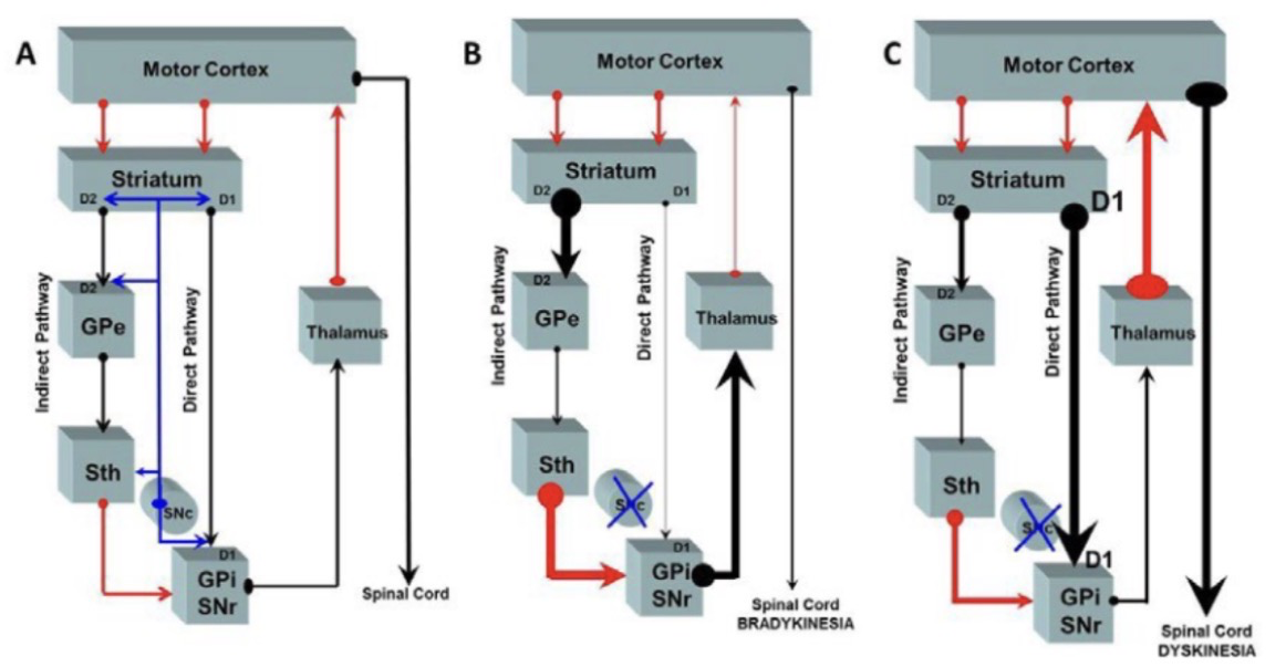 <p><strong>B. Bradykinesi (Parkinson)</strong></p><ul><li><p>↓ dopamin (SNc förstörs)</p></li><li><p>↓ direkt väg + ↑ indirekt väg</p></li><li><p>→ GPi/SNr överhämmar thalamus</p></li><li><p>→ mindre signal till cortex</p></li></ul><p>Resultat: hypokinesi / långsamma rörelser</p>