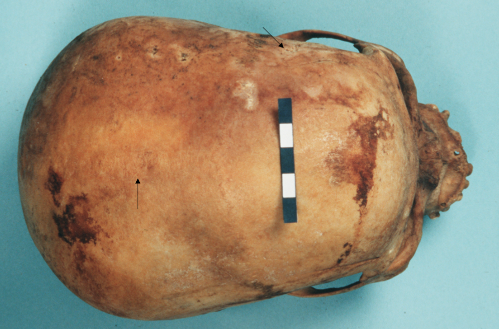 <p>what is the score for the coronal and sagittal sutures sutures of this skull (0-3)?</p>