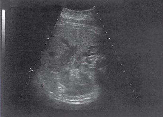 <p>Triangular-shaped adrenal appears to “cap” upper renal poles; appease as low-gray organ that is typically hypoechoic relative to liver, spleen, and renal cortex</p>