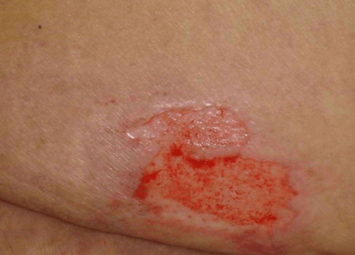 <p>partial thickness</p><p>skin loss of dermis and epidermis</p><p>red, pink, moist blistered</p>