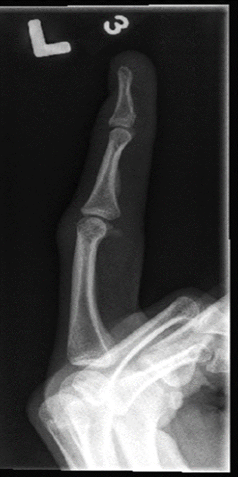 <p>What projection is this finger x-ray?</p>