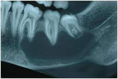 <p>a radiolucent lesion that appears to extend up the periodontal ligament and between the roots.</p>