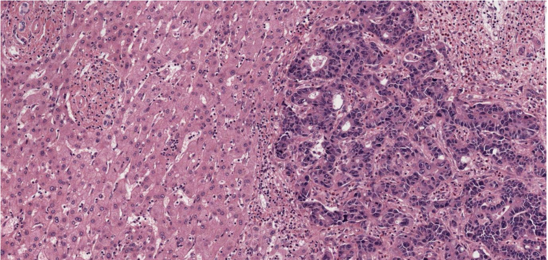 <p>Liver tissue infiltrated by irregular and sometimes cribriform glands, the nuclei of the cells are pleomorphic and hyperchromatic. Necrotic debris is evident. There is a desmoplastic (densely fibrotic) response.</p><p>Morphologically, there is gland formation, typical for colonic mucosa, but not for the liver. Immunohistochemistry for markers characteristic of particular tissues (e.g., colon) could also be used. This is common practice in pathology.</p>