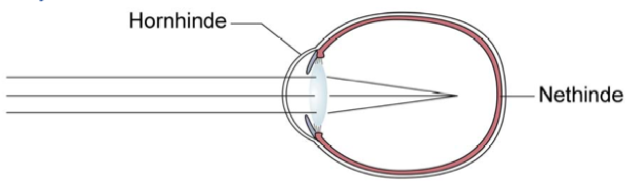 <p><strong>Nærsynethed</strong>, hvor øjet enten er <strong>for langt</strong>, eller brydningen er <strong>for stærk</strong>, så billedet af fjerne objekter dannes <strong>foran retina</strong>.</p>