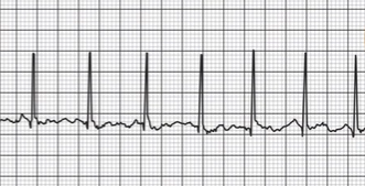 <p>QRS complexes present</p><ul><li><p>R to R is much smaller than normal pace</p></li></ul><p></p>
