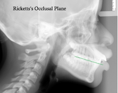 <p>which reference plane:</p><p>- Point 1: Molar occlusal contact</p><p>- Point 2: 1st premolar occlusal contact</p>
