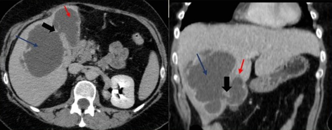 <p>Pericholecystic - or liverabscess.</p>