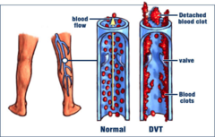 <p>an acute venous obstruction (clot) that is most frequently secondary to a thrombus in a deep vein of the lower extremities</p>