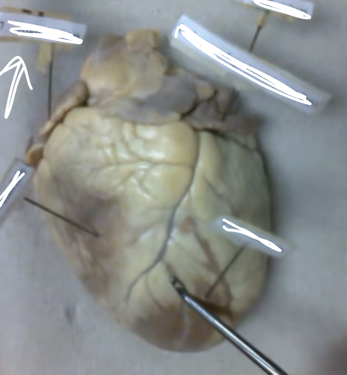 <p>(inside R auricle)</p>