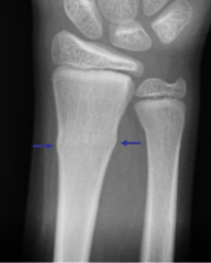 <p>fracture ends are driven into each other</p><p>often seen in kids</p><p>*differs from impacted fx: m/c in kids, not a complete break in the bone</p>