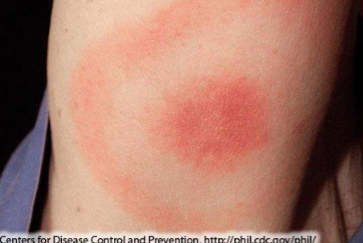<ul><li><p>occurs in 70 to 80% of infected persons</p></li><li><p>Begins at the site of a tick bite after 3 to 30 days (average= 7 days)</p></li><li><p>Expands gradually up to 12 inches or more across</p></li><li><p>warm to the touch but rarely itchy or painful</p></li><li><p>Sometimes clears as it enlarges, resulting in a target or “bull’s-eye” appearance</p></li></ul><p></p>