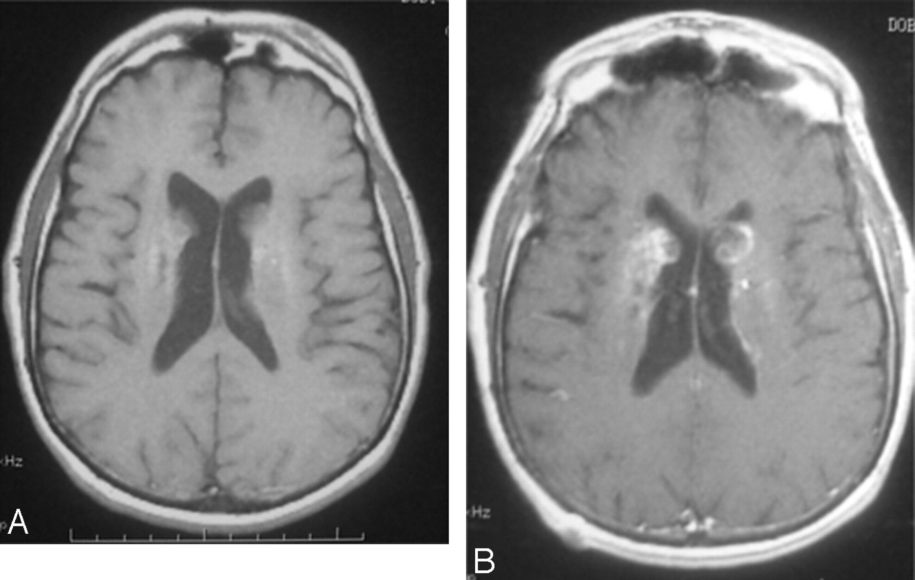 <p><strong>Answer:</strong><br><strong>Cryptococcal meningitis</strong>, likely due to undiagnosed HIV.</p><p></p><p><strong>Key clues:</strong></p><ul><li><p>IV drug use → increased risk for HIV</p></li><li><p><strong>Subacute/chronic meningitis</strong></p></li><li><p>Markedly increased intracranial pressure → papilledema and CN VI palsy</p></li><li><p>Hydrocephalus</p></li><li><p>CSF: lymphocytes ↑, protein ↑, glucose ↓</p></li></ul><p><strong>Important correction:</strong> Cryptococcus often has very few CSF white cells in <strong>advanced AIDS</strong>, but that is not required. It can still produce lymphocytic pleocytosis. Both cryptococcal and tuberculous meningitis can cause hydrocephalus, but the HIV-risk clue makes <strong>Cryptococcus</strong> more likely here.</p>