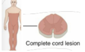 <p><span style="background-color: transparent;"><span>-Bilateral loss of all modalities</span></span></p><p><span style="background-color: transparent;"><span>-Bilateral leg weakness</span></span></p><p><br></p>